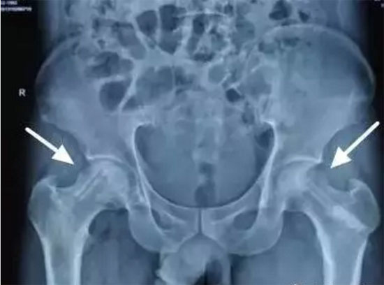 郭氏堂:股骨头坏死,骨头最常患的一种疾病!